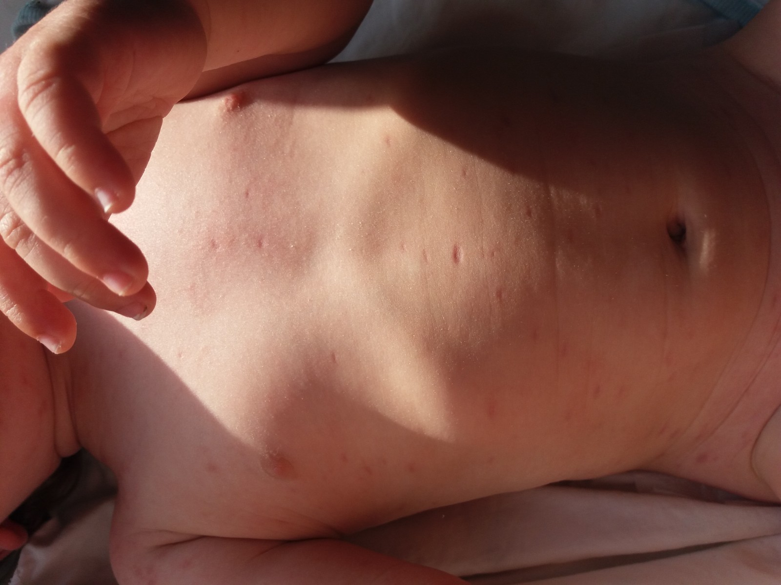 Baby met eczeemklachten — behandelresultaat