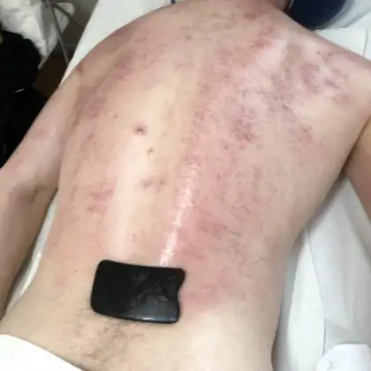 Gua Sha behandeling